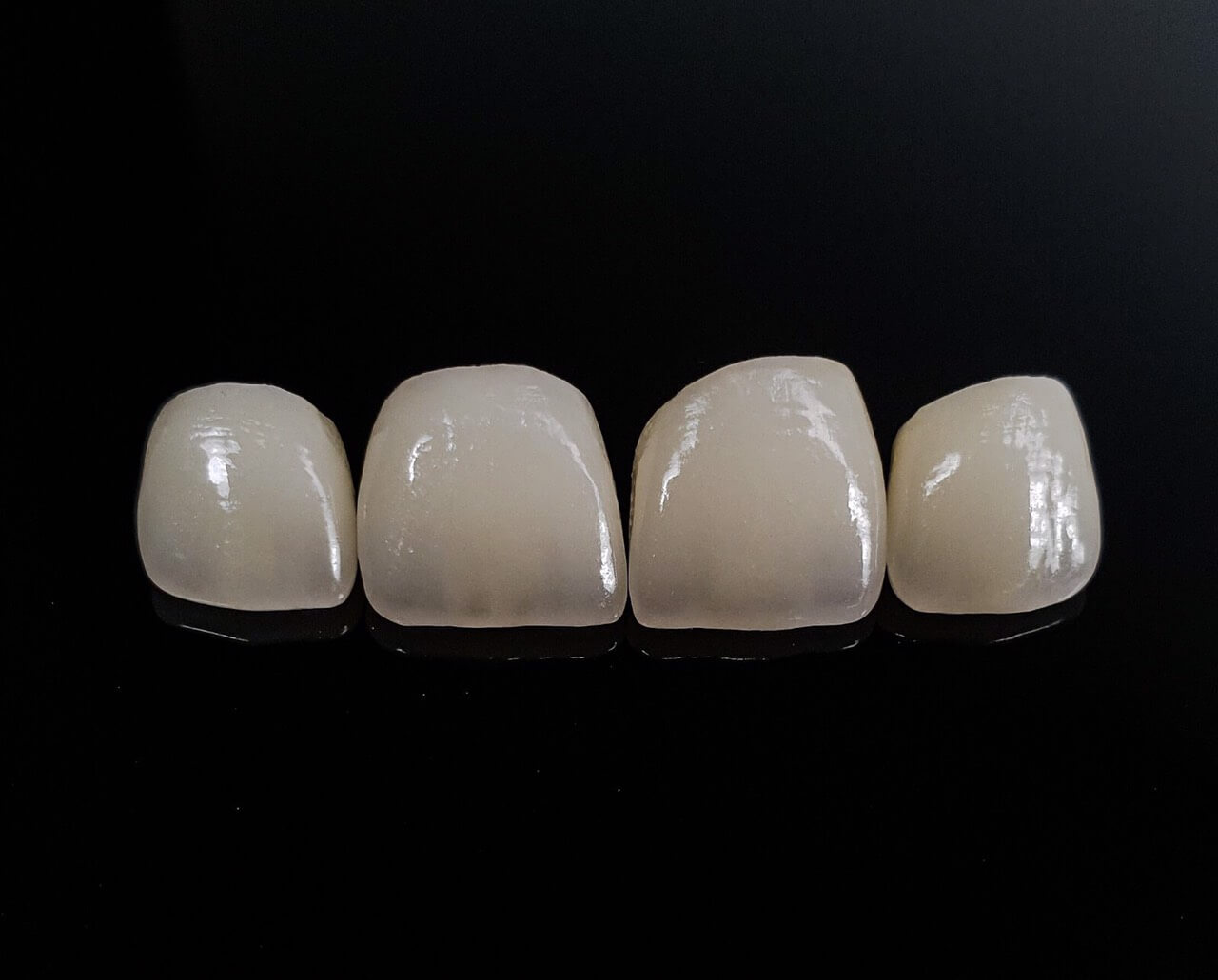 bezmetalova-keramika-stomatologiya_2